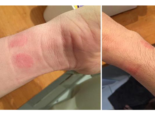 想買Apple Watch？小心皮膚過敏發(fā)紅！