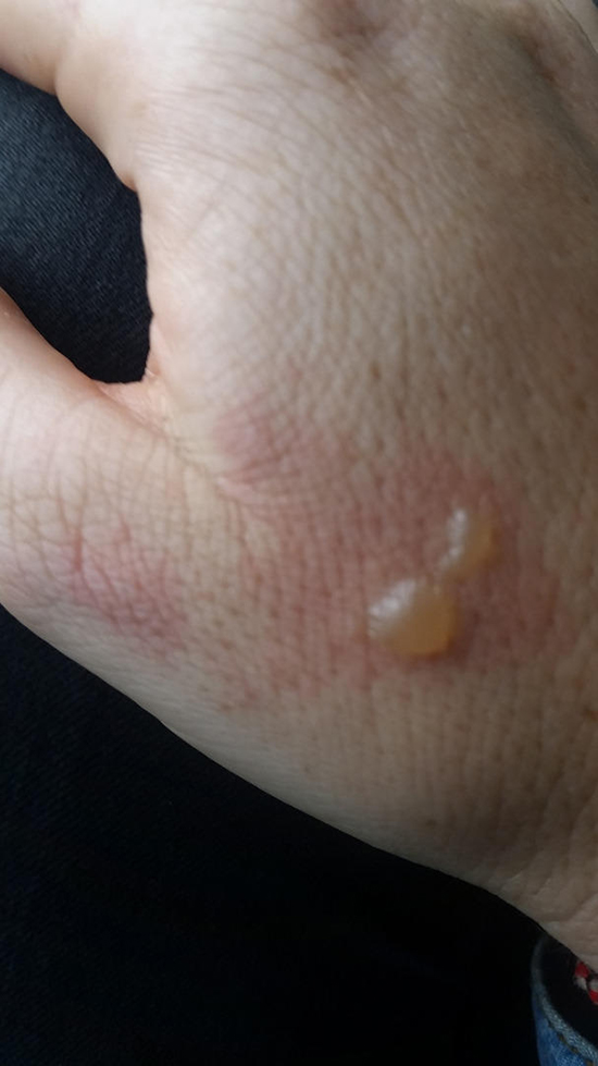 耳機爆炸燒傷用戶 蘋果：這不是我們的問題